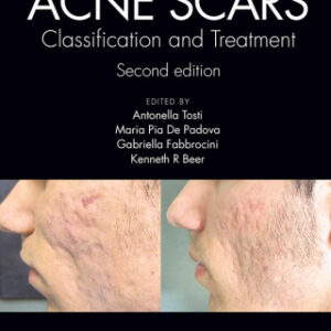 Acne Scars 2nd Edition Classification and Treatment, Second Edition - Original PDF